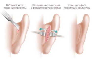 otoplastika