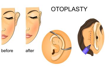 1612448624_1513173896_otr_otoplasty-1
